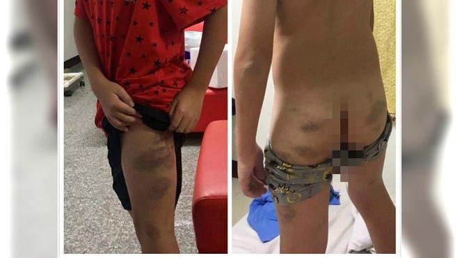 Thi không đạt 95 điểm, bé trai bị mẹ đánh đập dã man khiến toàn thân bầm tím